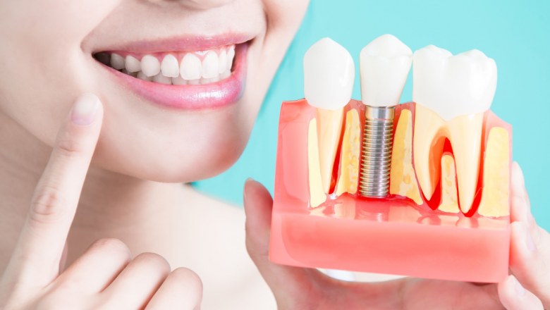 Tratamentos com implantes dentários são excelentes para solucionar problemas de falta de dentes