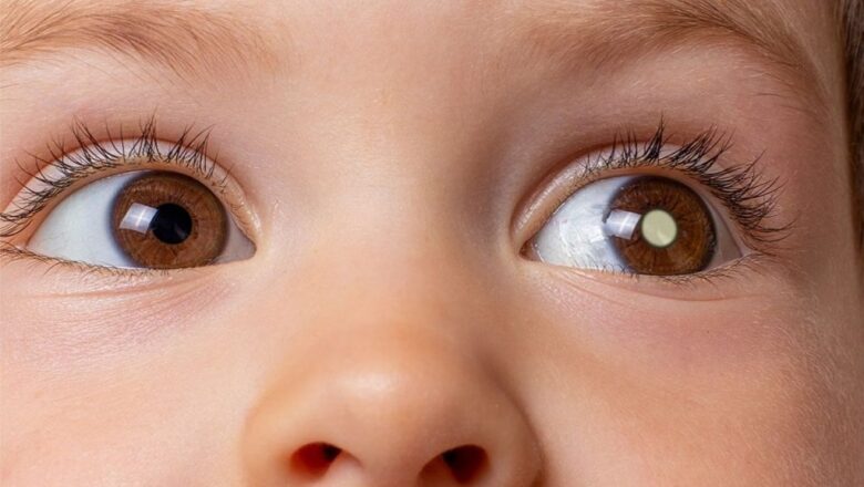 Especialistas explicam o retinoblastoma, câncer que acomete os olhos de crianças