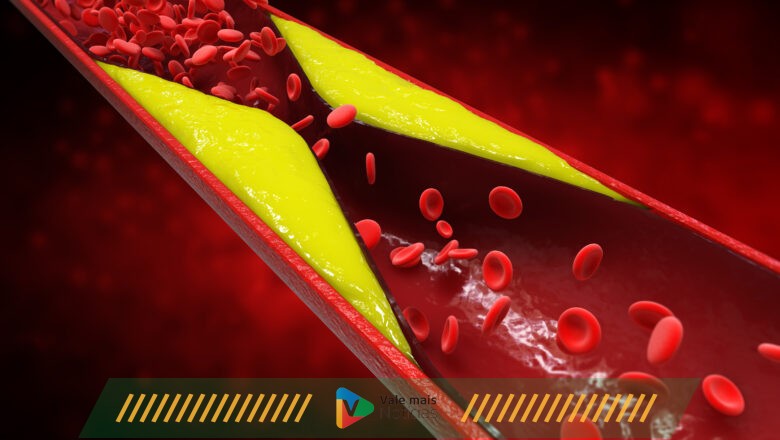 Aterosclerose e arteriosclerose representam risco à saúde arterial dos homens