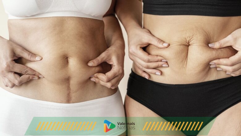 Flacidez: como ter um corpo saudável e mais disposição
