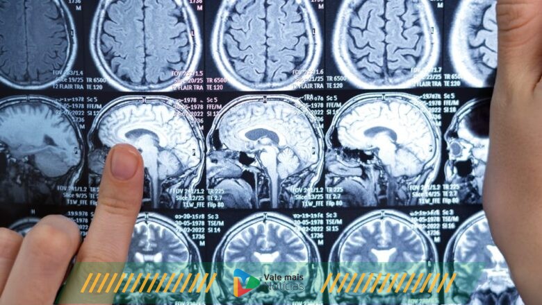 Incidência de AVC tem aumentado em jovens e pessoas de meia-idade