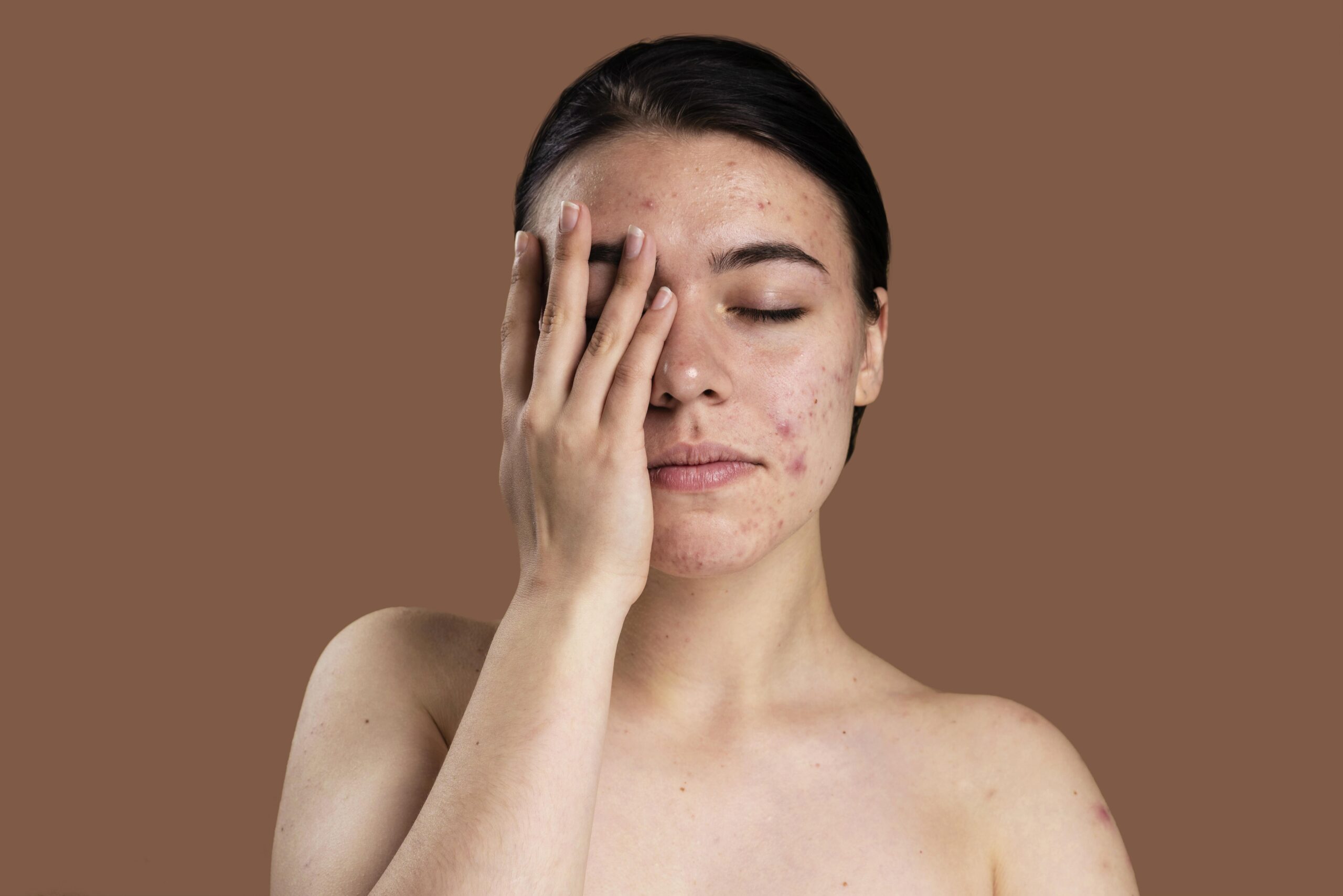 Regulação hormonal: A acne na pele de mulheres maduras