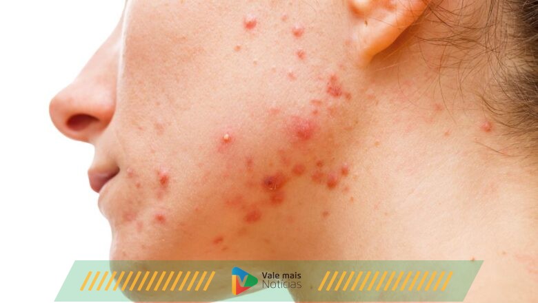 Dra. Fernanda Cassain explica Mitos e Verdades sobre acne na mulher adulta