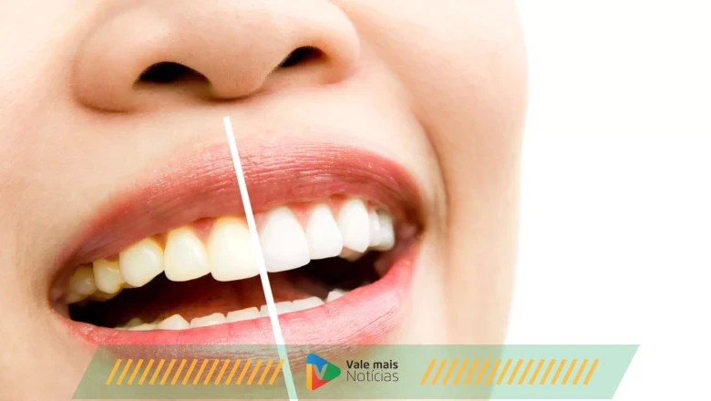 Tudo o que você precisa saber sobre clareamento dental